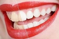 Gelbe Zähne
